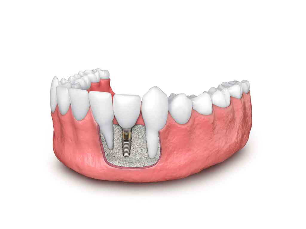 Bone Grafting